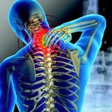 Cervicobraquialgias.