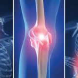 Dolor Crónico Musculoesquelético.